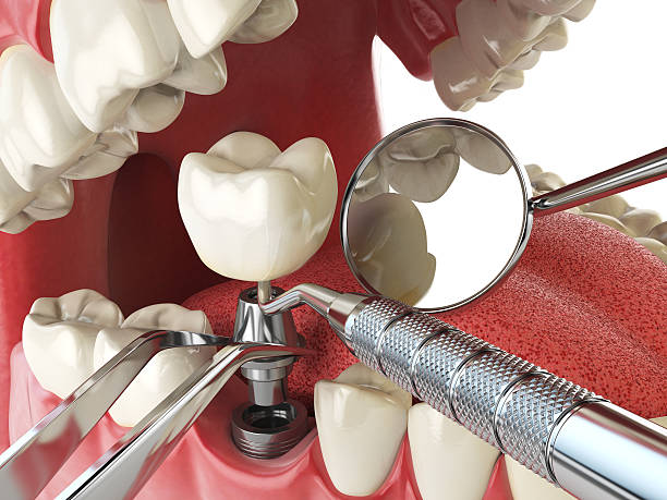 Best Emergency Wisdom Tooth Extraction in Willowick, OH